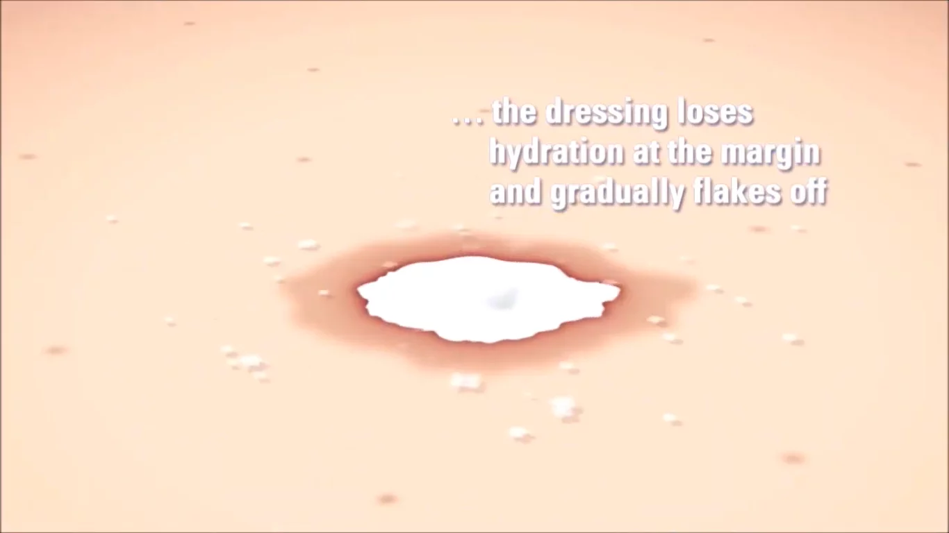 More powder may be added as needed. Dressing dries and flakes off as the wound heals.